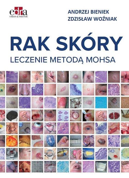 

Rak skóry Leczenie metodą Mohsa Bieniek, Woźniak