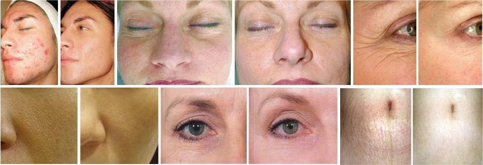 Derma Roller 3w1 Gold Ciało Twarz Oczy 0,2/0,5/1,5 Zasilanie brak