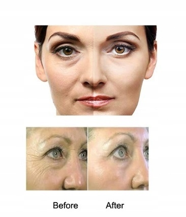 3x Derma Roller CIAŁO TWARZ OCZY TYTAN Dermaroller Marka Calissimo