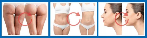 Lipo Lab 10ml lipoliza Lipo Lax + igła strzykawka Marka IT Pharma