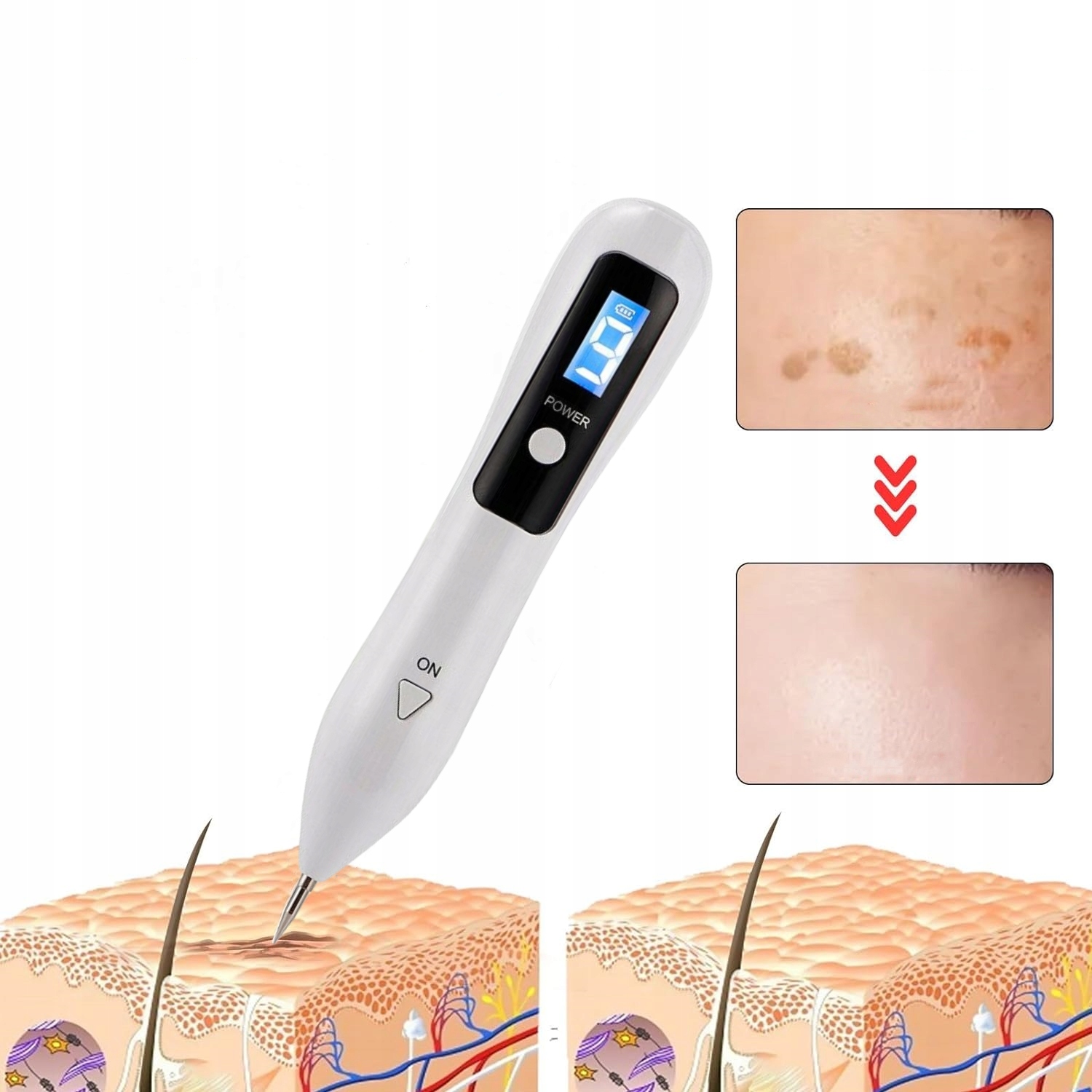 PLASMA PEN PLAZMA LASEROWE USUWANIE BLIZN TATUAŻY BRODAWEK PIEPRZYKÓW Moc 5 W