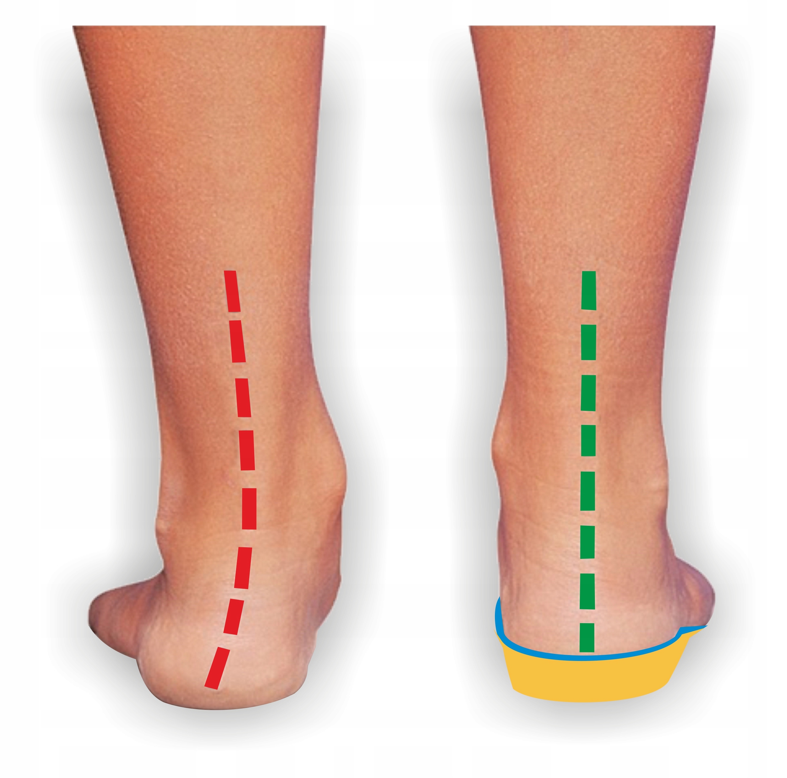 WKŁADKI DO BUTÓW ORTOPEDYCZNE DZIECIĘCE KOŚLAWOŚĆ PROFILOWANE OBUWIA 34/35 Marka Corbby