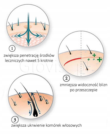 Glovis Roller 0.5 Wypadanie Łysienie Zagęszczanie Rodzaj mezoterapii igłowa