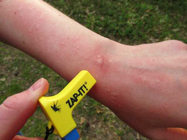 

Zap-It na ugryzienia owadów komarów os mrówek