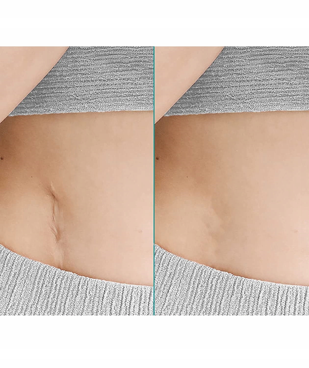 PLASTRY SILIKONOWE NA BLIZNY POOPERACYJNE WIELOKROTNEGO UŻYTKU ROLKA 2m Kolor cielisty