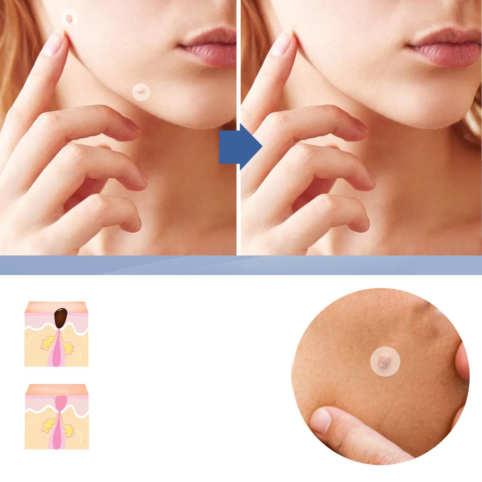 144 SZT. PLASTRY DO USUWANIA WŁÓKNIAKÓW Marka inna marka