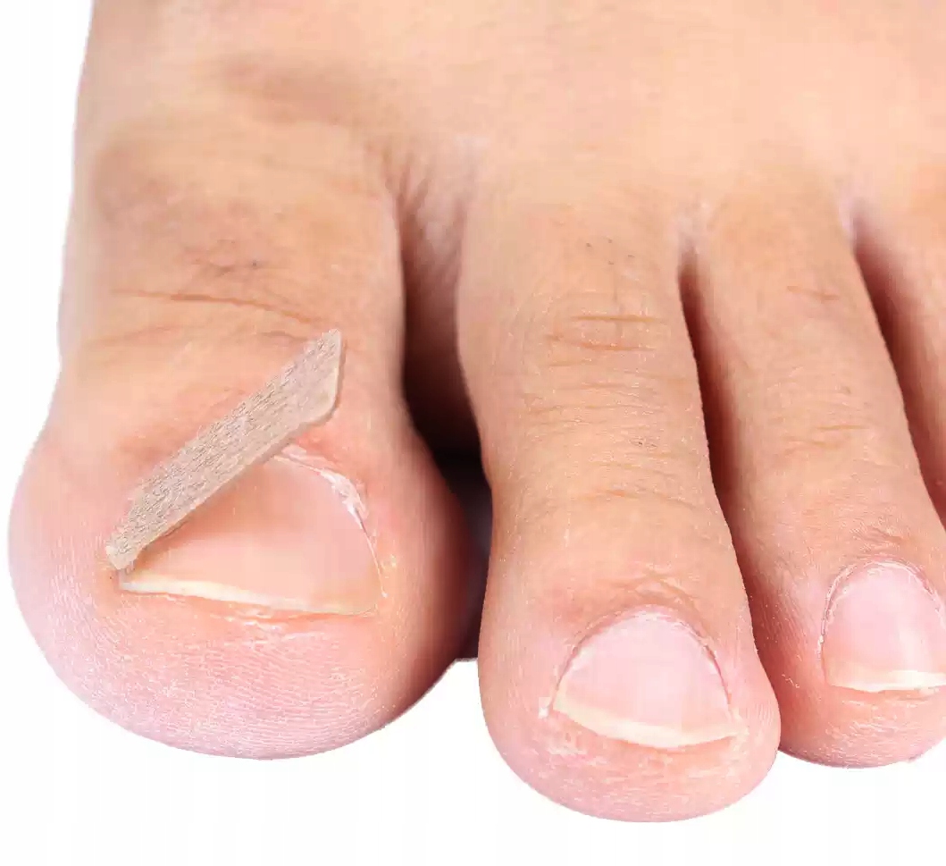 12 x PASKI ŁATKI na wrastające paznokcie, plastry Marka inna marka