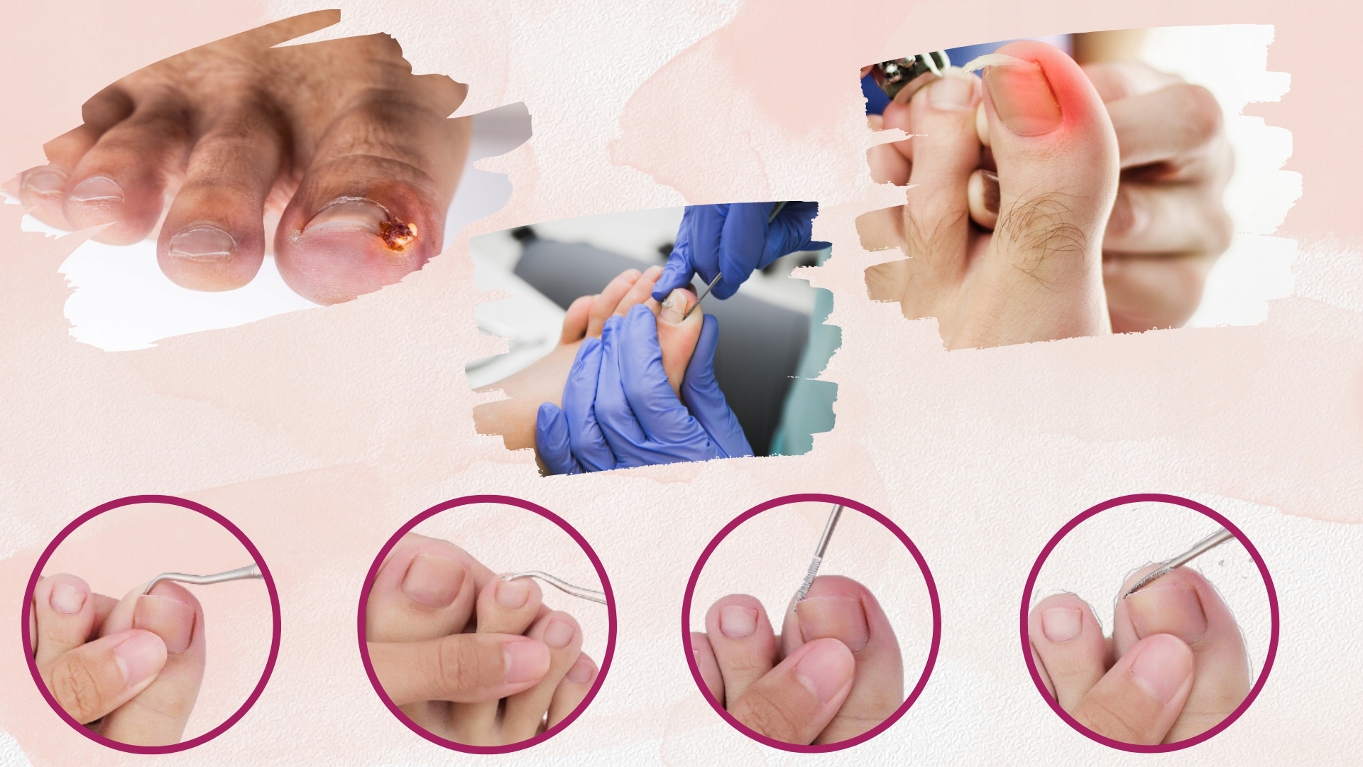 ZESTAW DO WRASTAJĄCYCH PAZNOKCI ŁYŻECZKI PODOLOG Marka bez marki