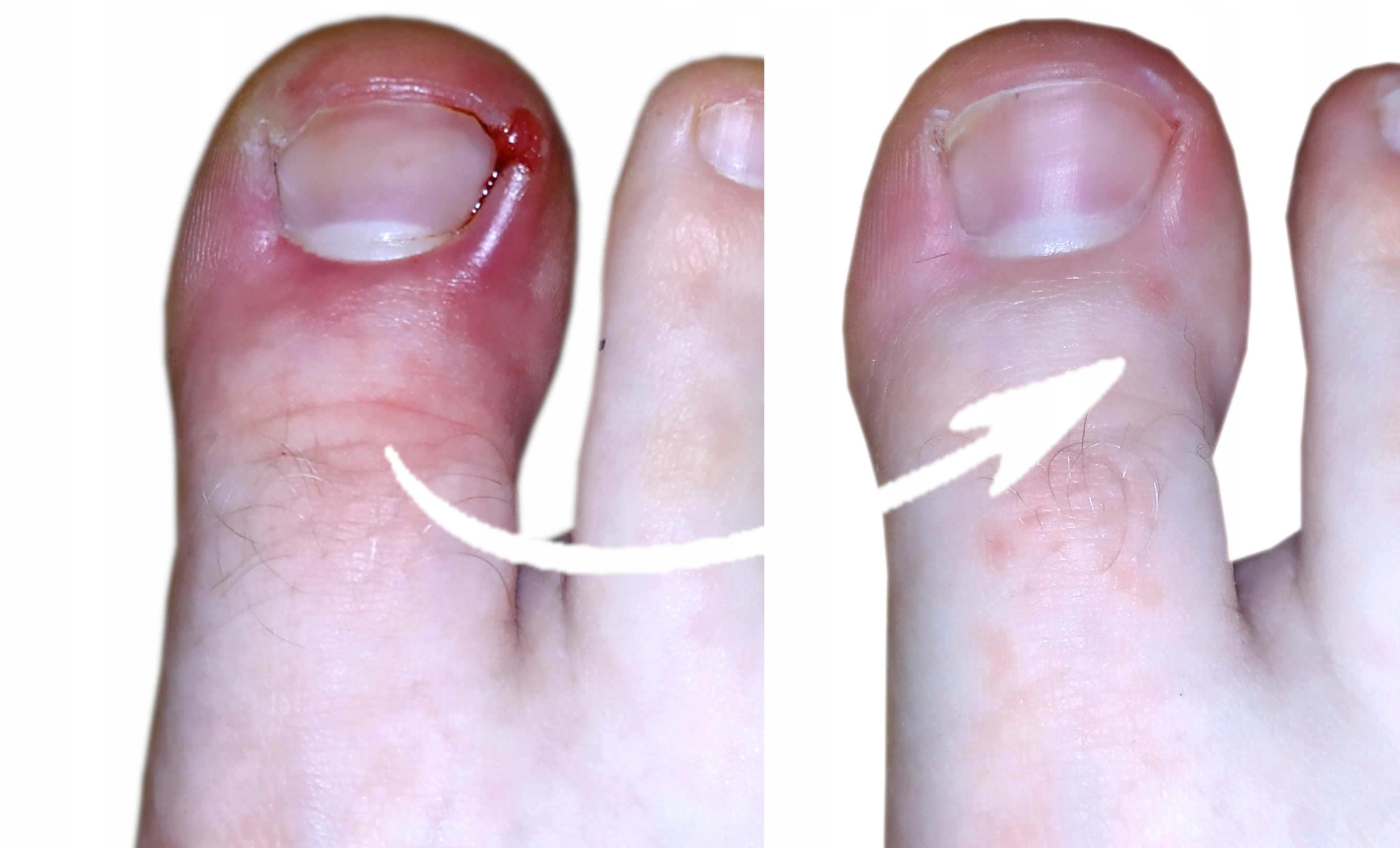 SPRAY NA GRZYBICĘ PAZNOKCI Z JONAMI SREBRA 100ml Rodzaj inny