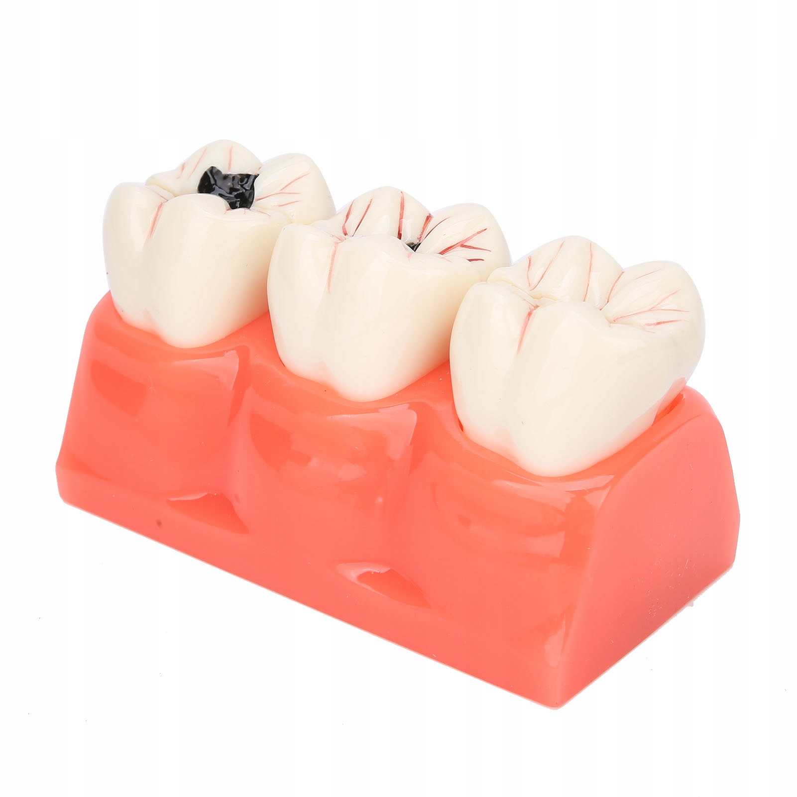 Model próchnicy zębów Model demonstracyjny próchnicy zębów Symulacja 95