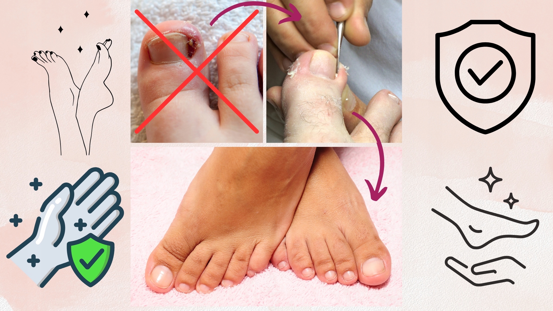 ZESTAW DO WRASTAJĄCYCH PAZNOKCI ŁYŻECZKI PODOLOG Rodzaj zestaw