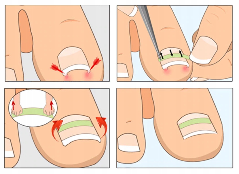 10 X Paski Na Wrastajace Paznokcie Klej Klamra 8336545436 Allegro Pl