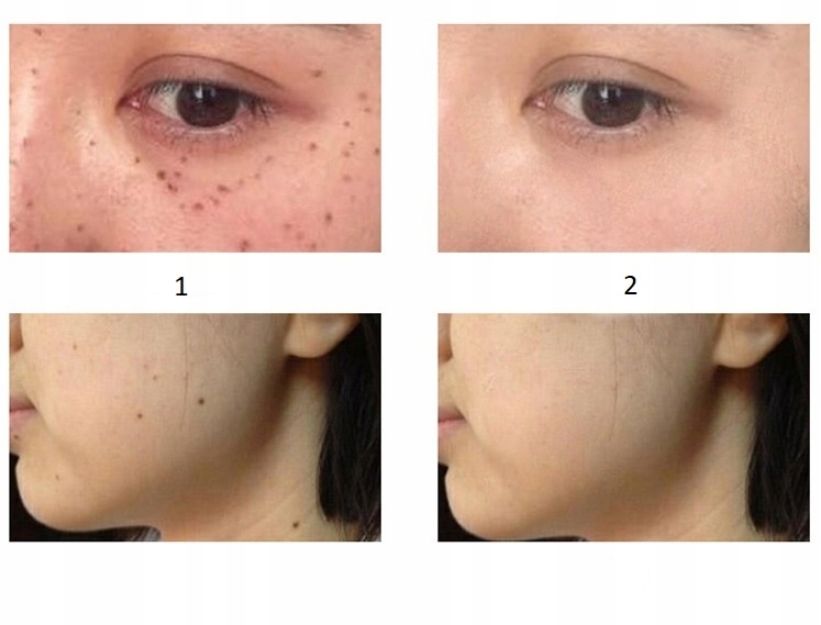 LASER PEN PLAZMA USUWANIE TATUAŻU BLIZN BRODAWEK Rodzaj laser IPL