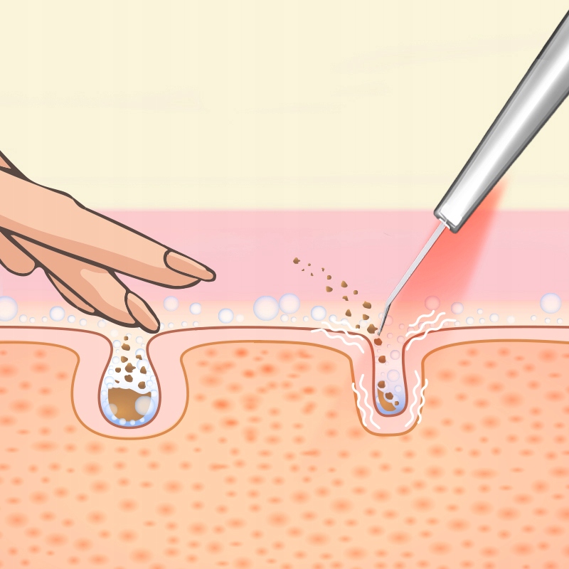 LUMINEO Płyn do peelingu kawitacyjnego - tonik hialuronowy - lifting 400ml Rodzaj tonik