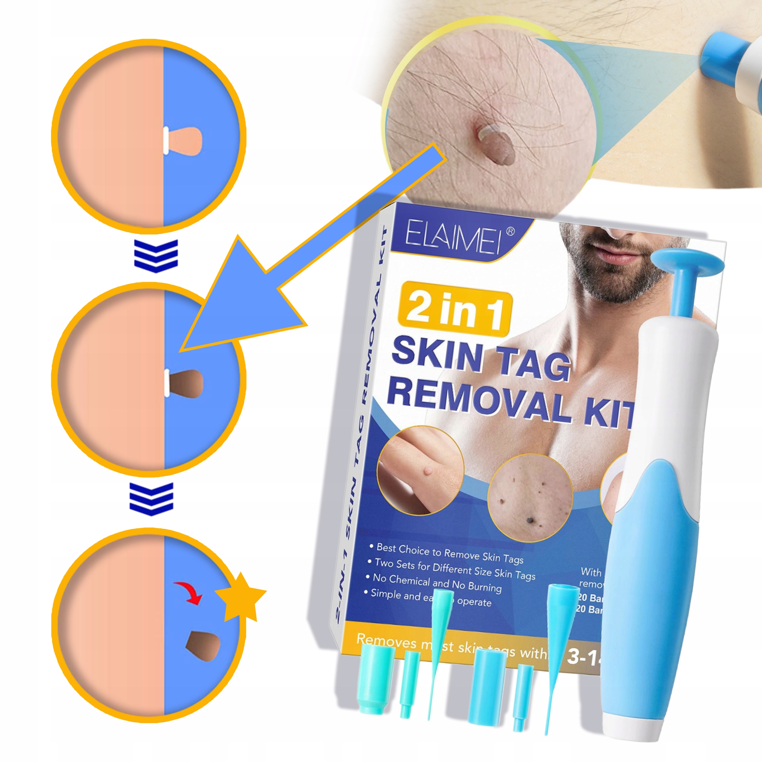 2 In1 Bezbolestné Auto Kůže Tag Mole Sada na odstraňování bradavic Nástrojů