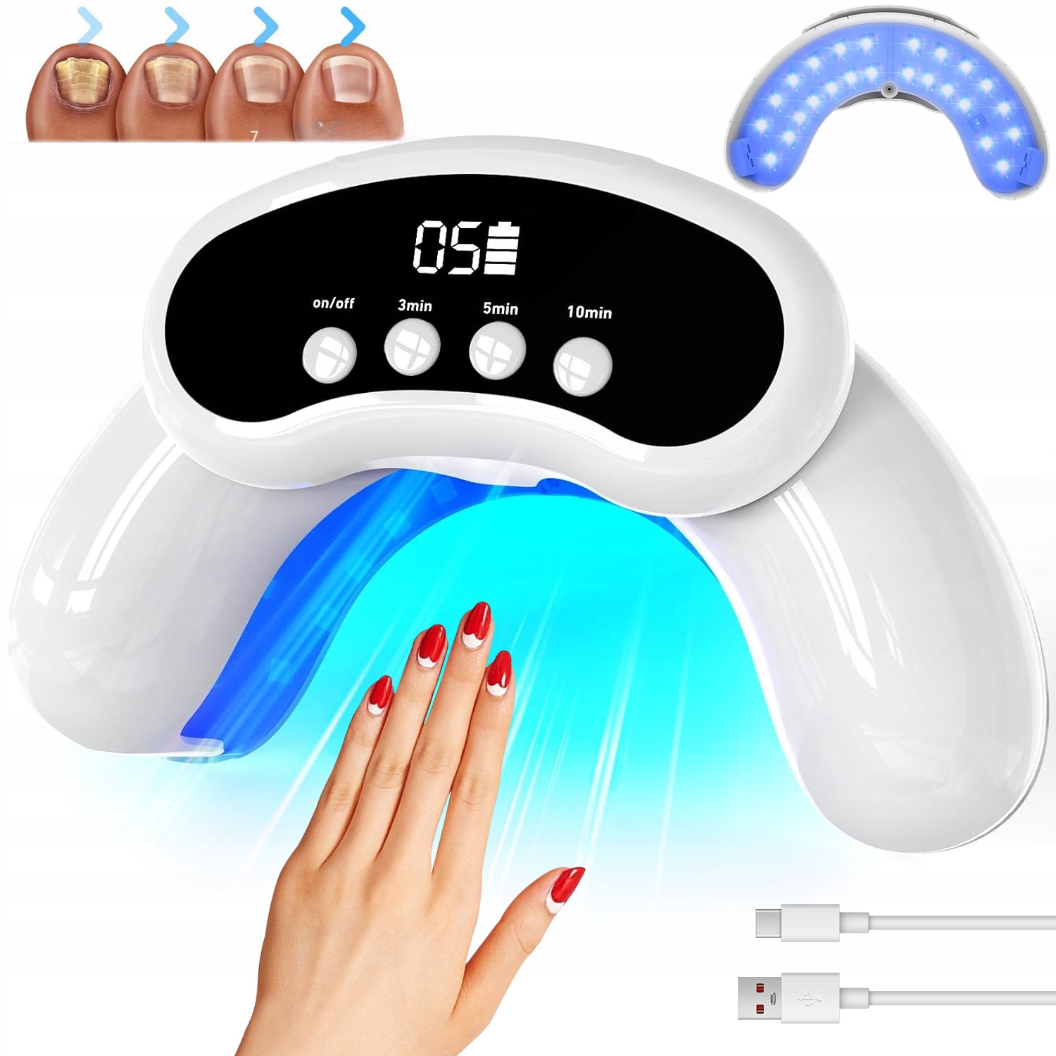 Protiplísňové Laserové Zařízení – Léčba Mykózy Nehtů Na Nohou