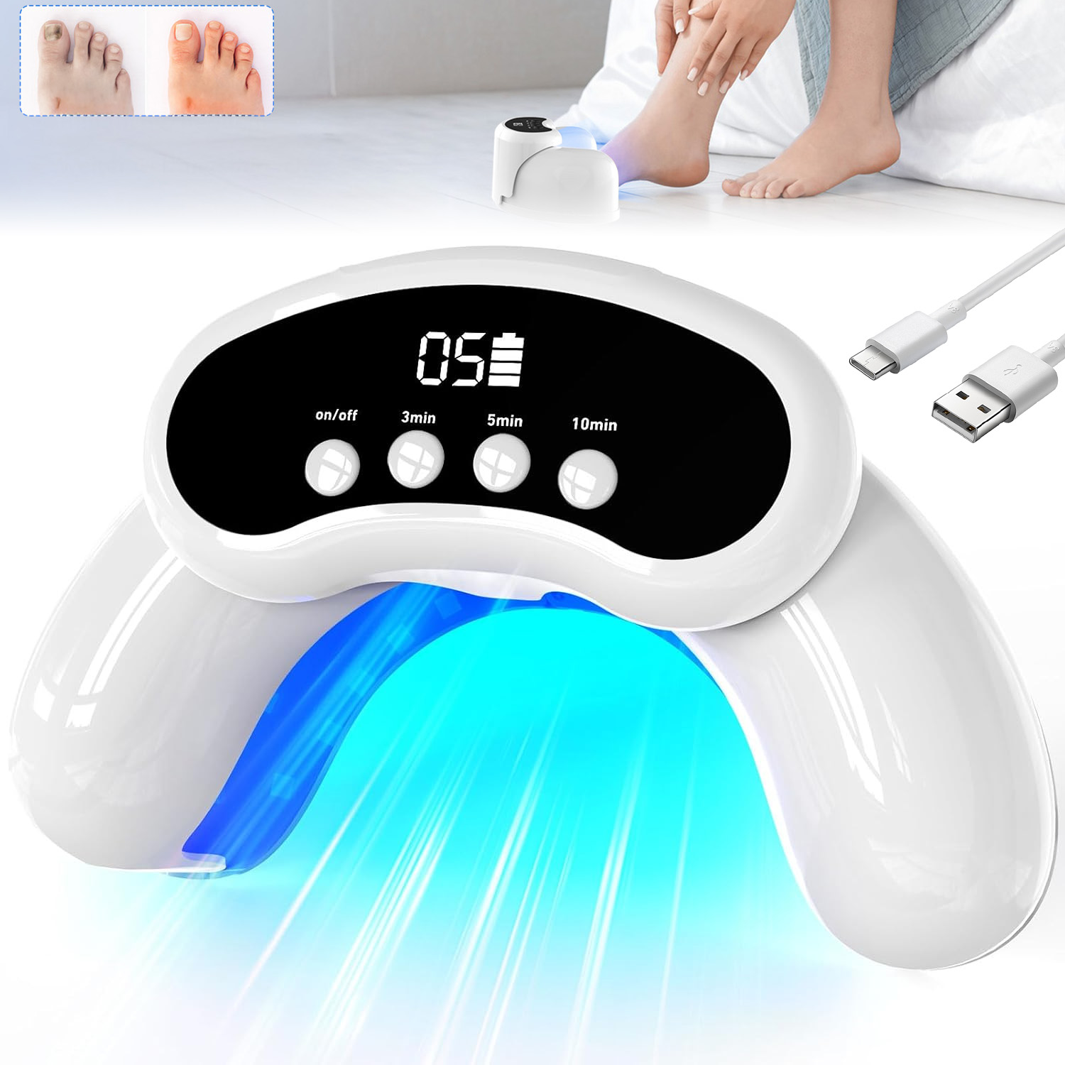 Laserové Zařízení Pro Léčbu Mykózy Nehtů, Bezbolestné, Účinné