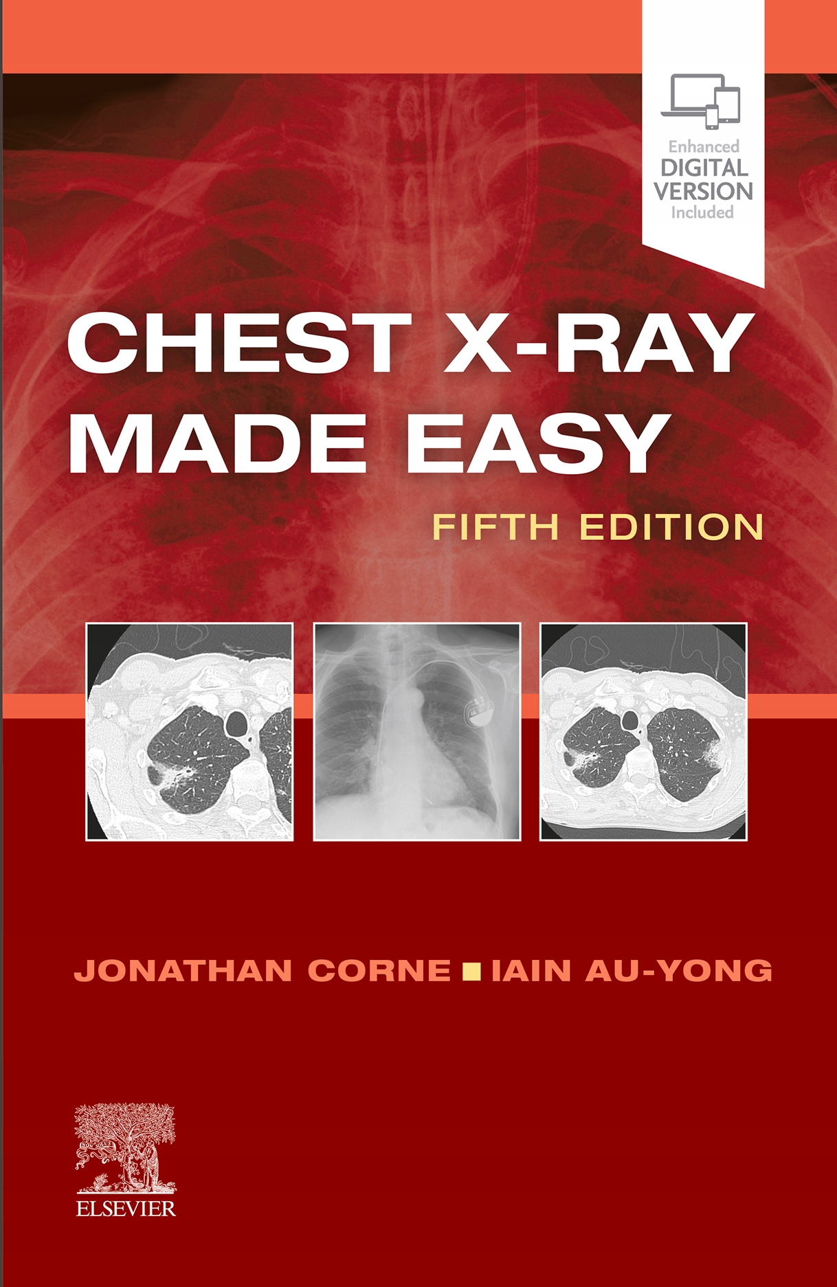 Chest XRay Made Easy EBook Corne, Jonathan (12596540696) Ebook
