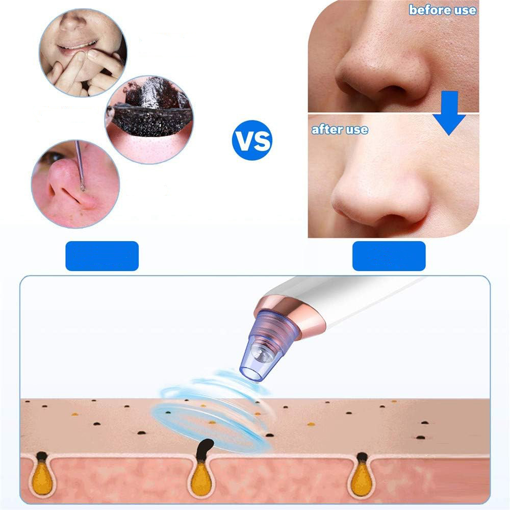 Odkurzacz DO USUWANIA WĄGRÓW PORÓW ZASKÓRNIKÓW NIEDOSKONAŁOŚCI Marka inna marka