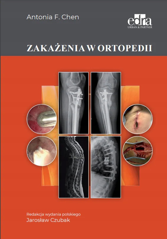 

Zakażenia w Ortopedii Antonia F. Chen Edra Urban