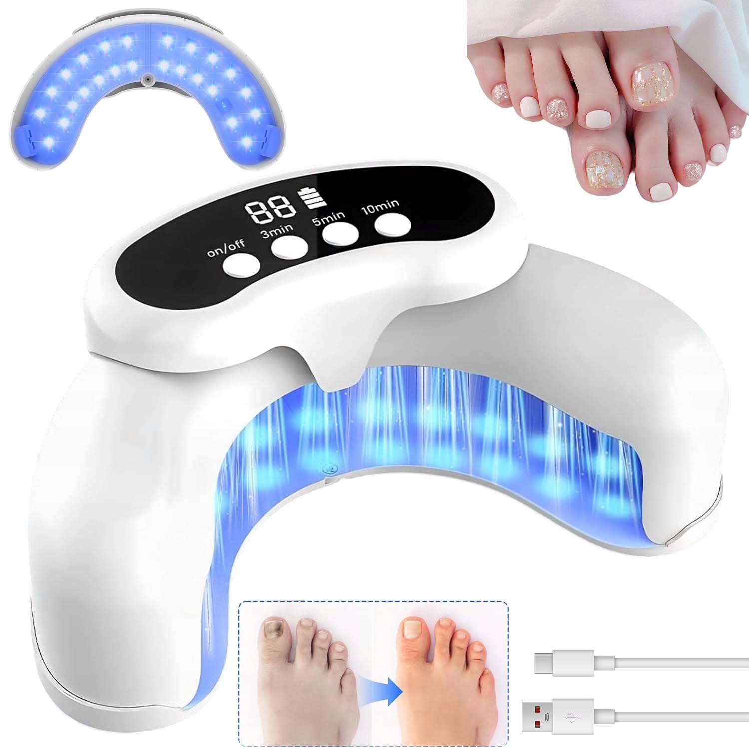 Protiplísňové Laserové Zařízení – Léčba Mykózy Nehtů Na Nohou