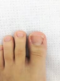 WRASTAJĄCE PAZNOKCIE Cążki Sonda Tamponada zestaw Skład zestawu sonda