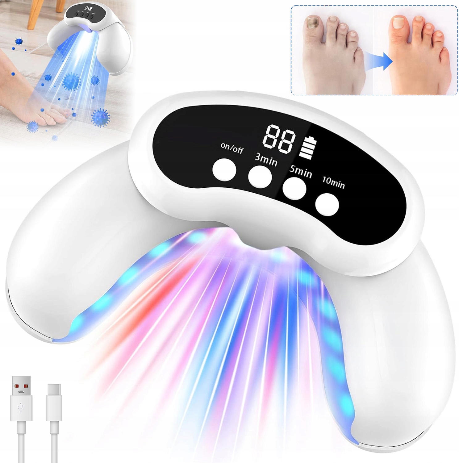 Léčba Mykózy Nehtů Doma Pomocí Laseru 905 Nm A Modrého Led 470 Nm