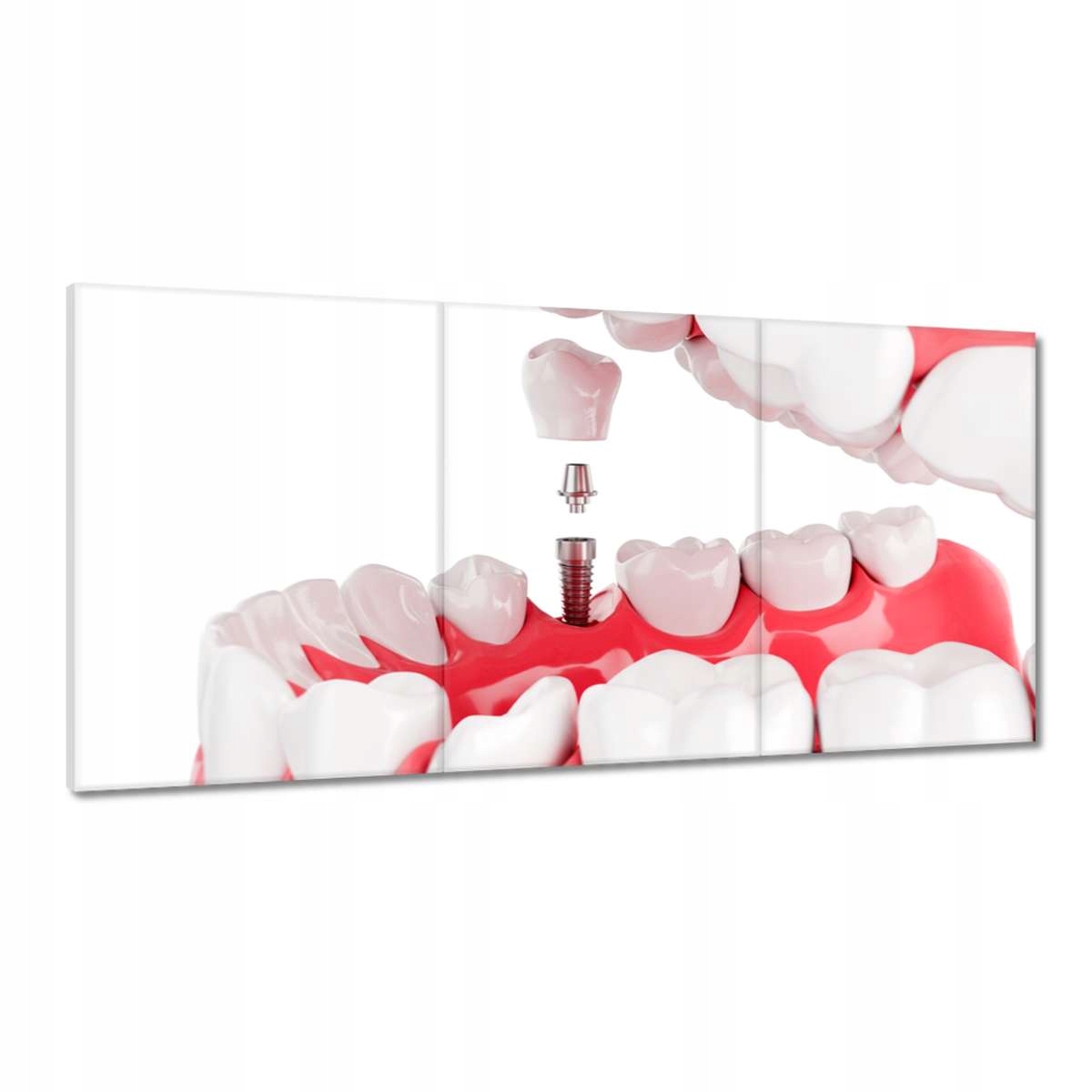 Obrazy 120x60 Zubní implantáty
