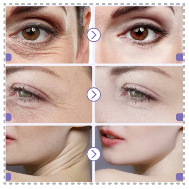 MASAŻER TWARZY BEZIGŁOWY 7W1 MEZOTERAPIA BEZIGŁOWA TERAPIA ŚWIATŁEM LIFTING Liczba igieł 0