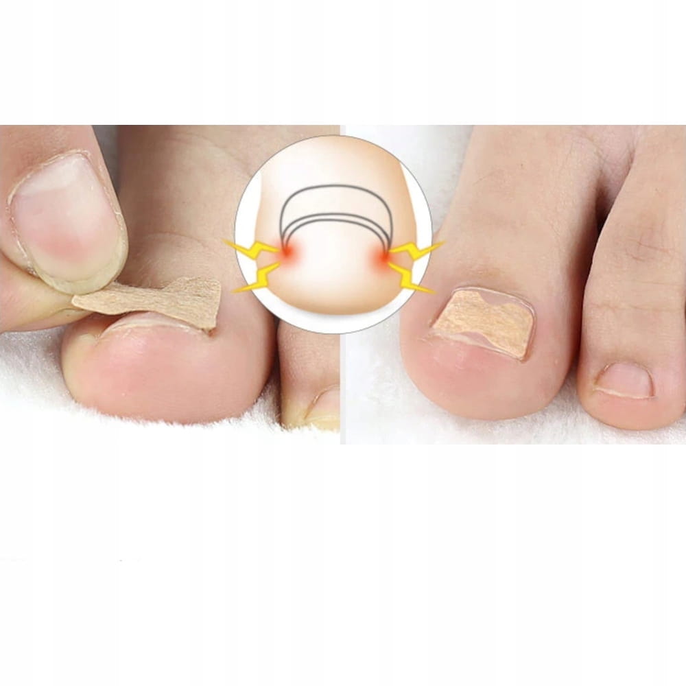 10 X PASKI NA WRASTAJĄCE PAZNOKCIE KLAMRA PLASTRY EAN (GTIN) 5903896515106