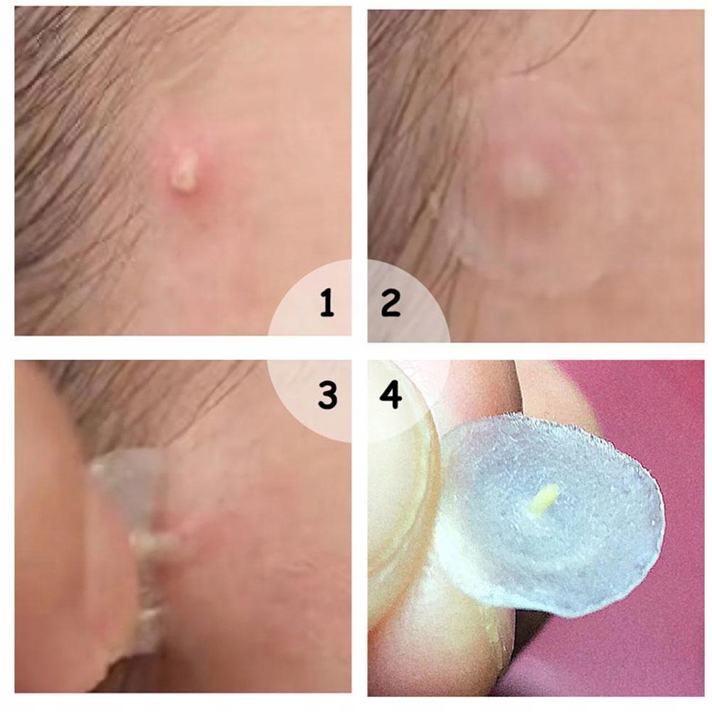 COSRX Acne Pimple Master Patch, 24 szt. - plasterki na wypryski — 12