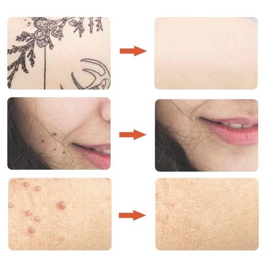 Plazmapen Laserowe Usuwanie Brodawek Blizn Tatuaży EAN (GTIN) 5905378115187