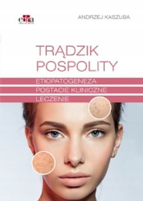 

Trądzik pospolity