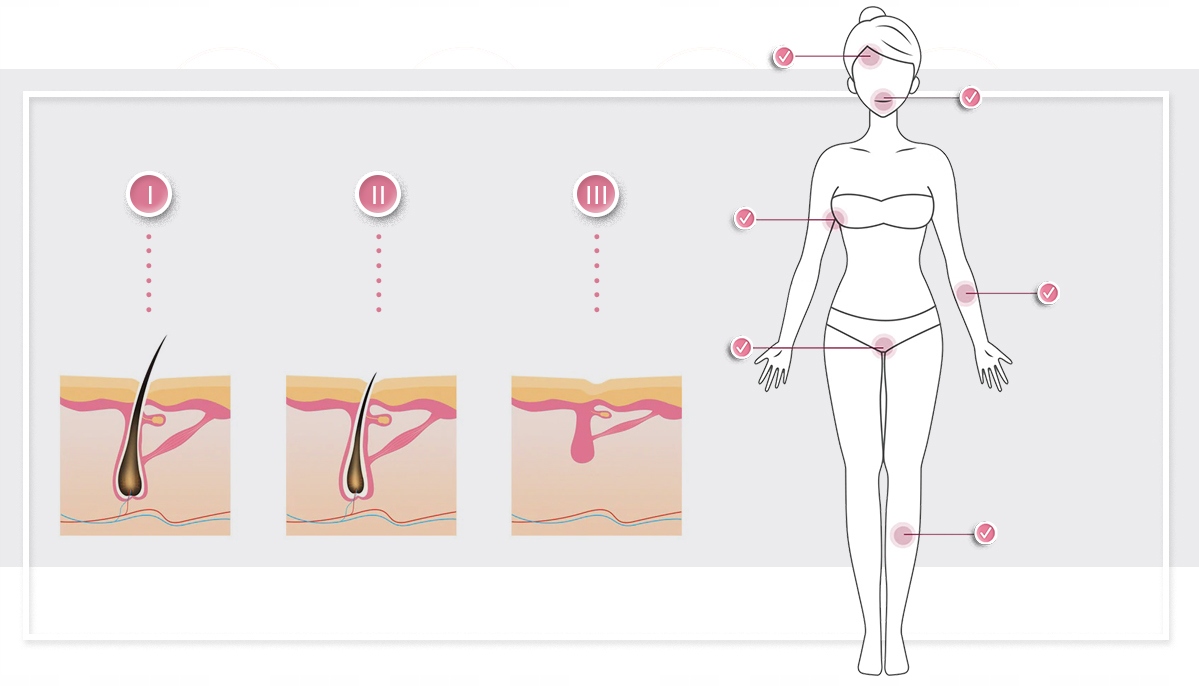 inFace DEPILATOR IPL do ciała + peeling do twarzy Zasilanie akumulatorowe