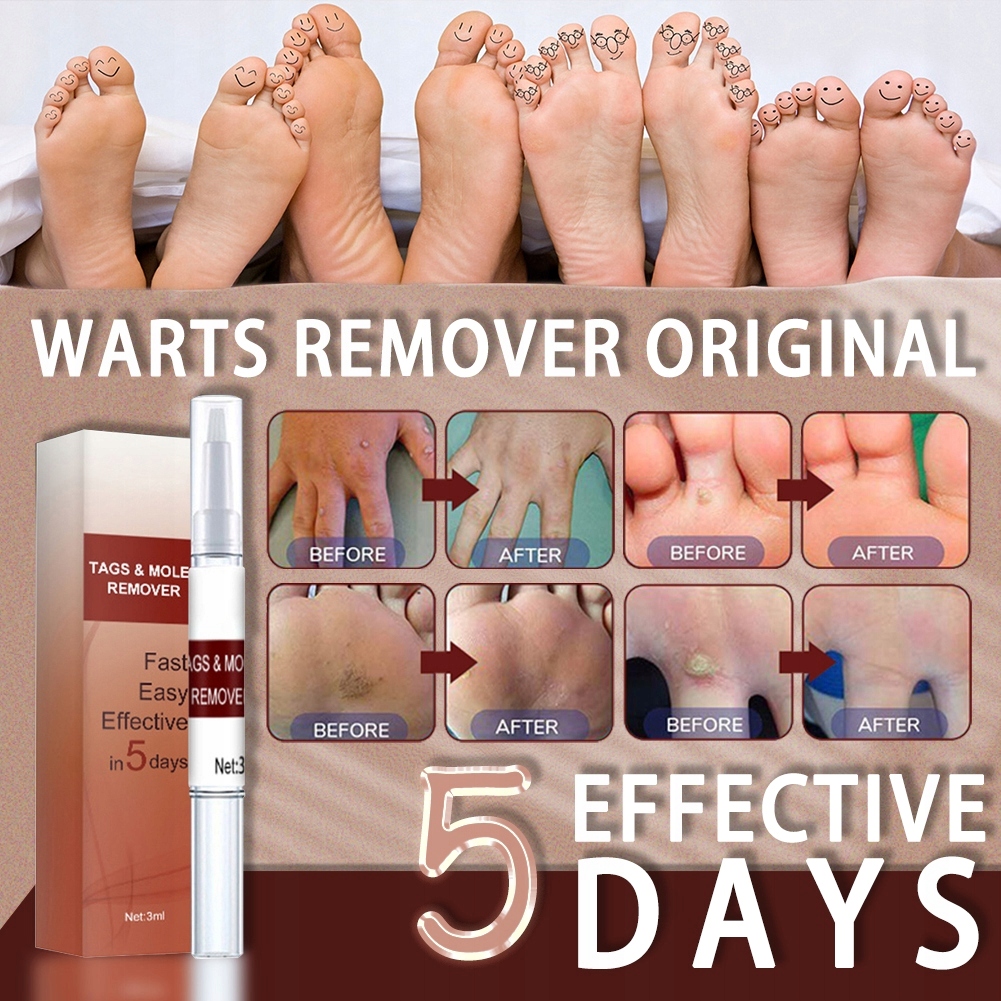 Środek Do Usuwania Pieprzyków I Brodawek Marka Oneofthose