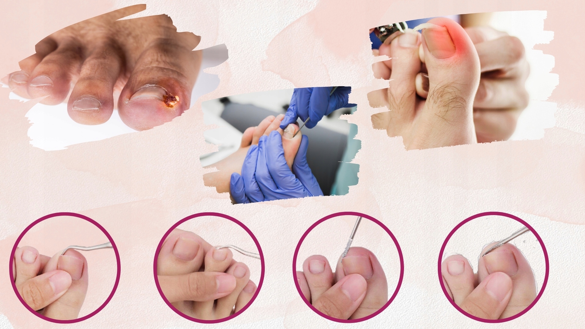 ZESTAW DO WRASTAJĄCYCH PAZNOKCI 3SZT PODOLOGICZNY DWUSTRONNY SONDA PODOLOG Marka inna marka