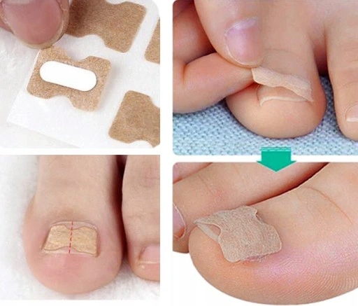 Paski plastry łatki na wrastające paznokcie | PL Marka inna marka