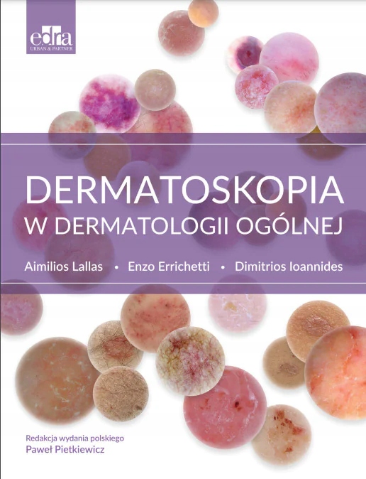 

Dermatoskopia w Dermatologii Ogólnej Edra Urban