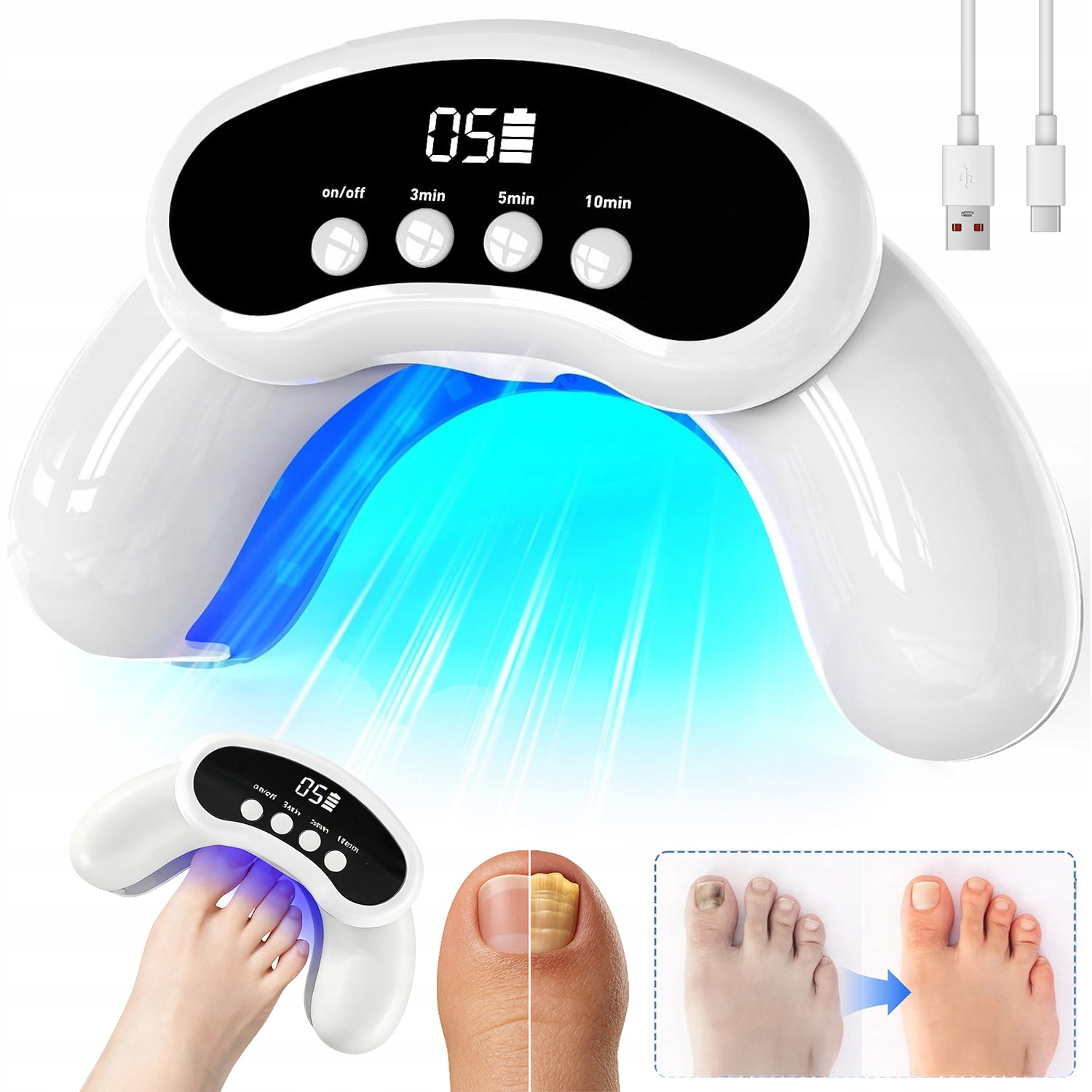 Protiplísňové Laserové Zařízení, Mykóza Nehtů, Ruce A Nohy, Trvalé