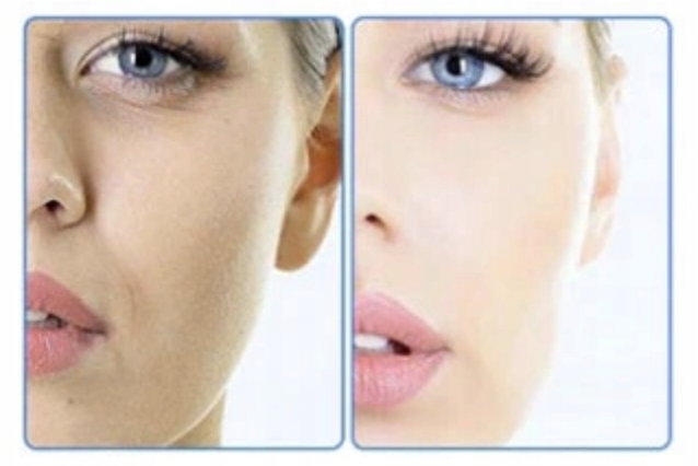 DO ODCHUDZANIA KAWITACJA LIPOSUKCJA ULTRADŹWIĘKOWA ANTYCELLULIT ZMARSZCZKI Rodzaj inny