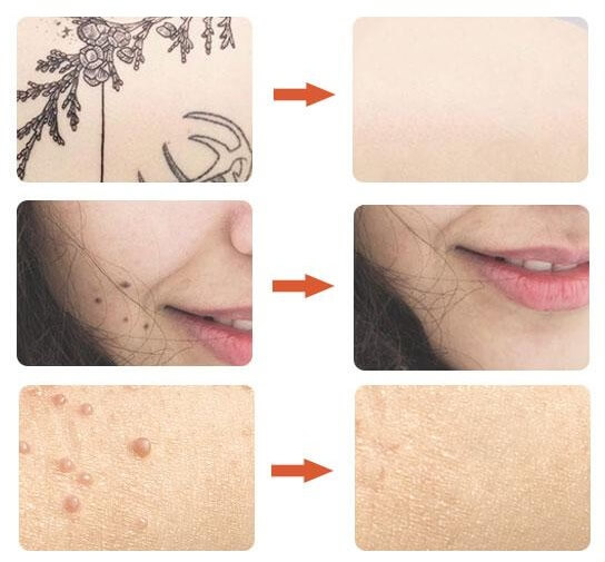 PLAZMAPEN LASEROWE USUWANIE BRODAWEK BLIZN TATUAŻY Rodzaj laser IPL