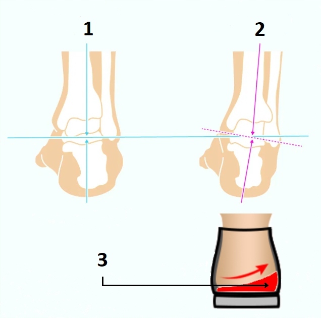 WKŁADKI ORTOPEDYCZNE NA SZPOTAWOŚĆ PRONUJĄCE VAYA Wykonanie gotowe
