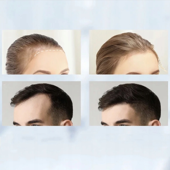 DERMA STAMP MICRO IGŁA Z REGULOWANĄ IGŁĄ 0MM-2.0MM PROFESJONALNA Stan opakowania oryginalne