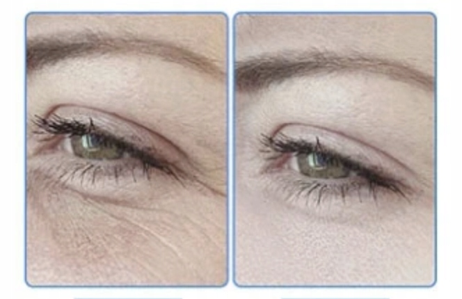 DO ODCHUDZANIA KAWITACJA LIPOSUKCJA ULTRADŹWIĘKOWA ANTYCELLULIT ZMARSZCZKI Marka inna marka