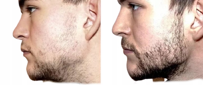 ROLLER DO BRODY ZAROSTU DERMA POROST WAŁEK WĄS Rodzaj kartacz