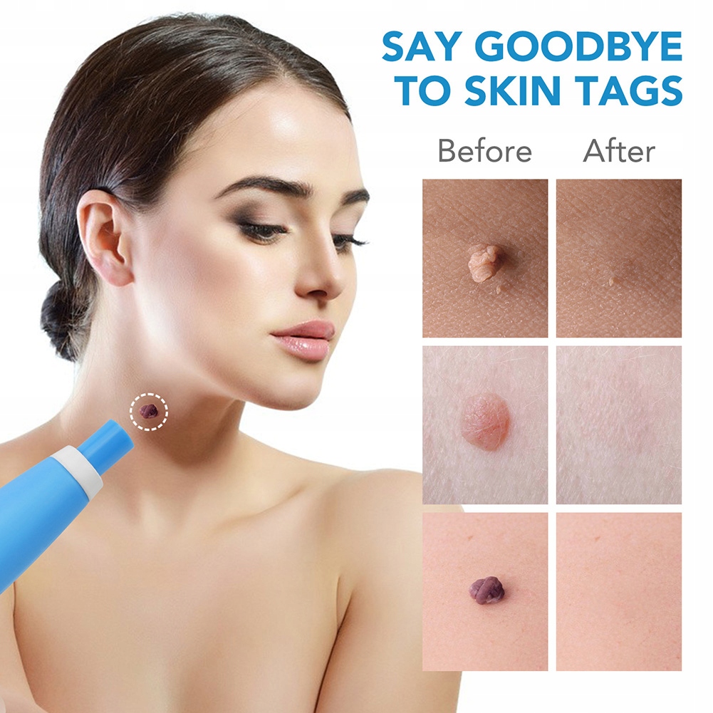 2 IN 1 Auto Skin Tag Remover Kit Micro Skin Tag Marka bez marki