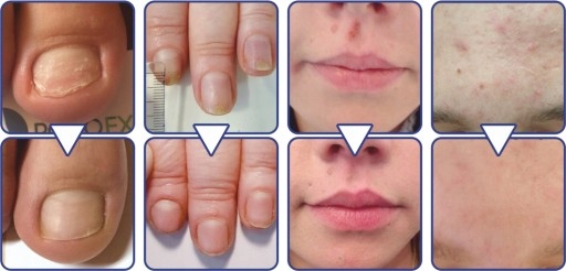 SERUM ARKADA TC16 11ML + OKLUZJA ONYCHOLIZA grzyb Marka Arkada