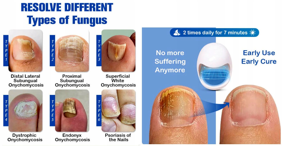 Laserowe Urządzenie Leczenie Grzybica Paznokc Kod producenta JJF-518WI