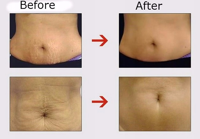 Naturalny krem naprawiający rozstępy ciążowe 100g Marka inna marka