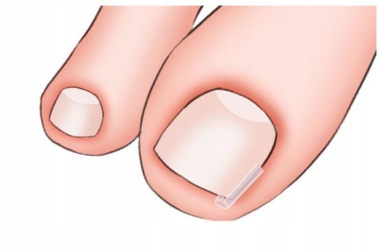 PASKI NA WRASTAJĄCE PAZNOKCIE KORYGUJĄCE ZAPOBIEGAJĄCE 10 SZT. Marka Beautiona